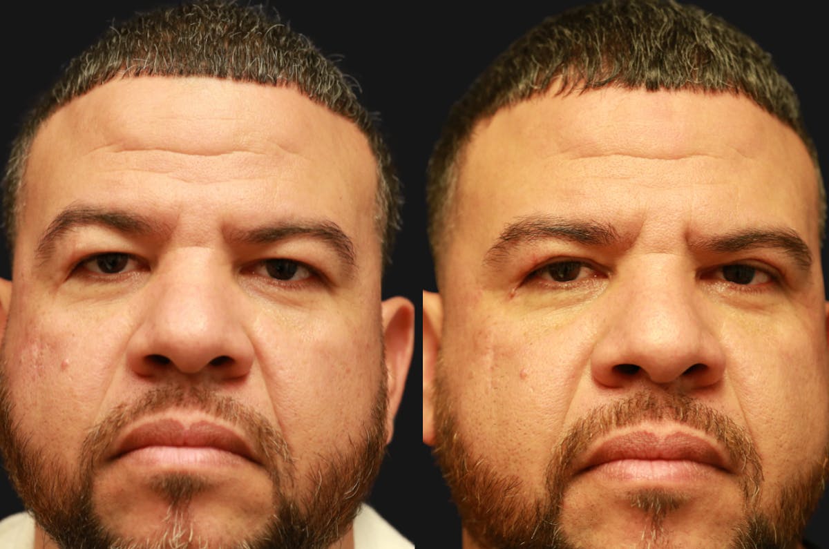 Upper Blepharoplasty Before & After Gallery - Patient 189183 - Image 1