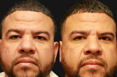 Upper Blepharoplasty Before & After Gallery - Patient 189183 - Image 1