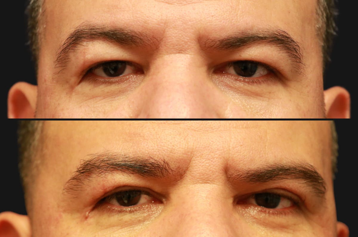 Upper Blepharoplasty Before & After Gallery - Patient 189183 - Image 2