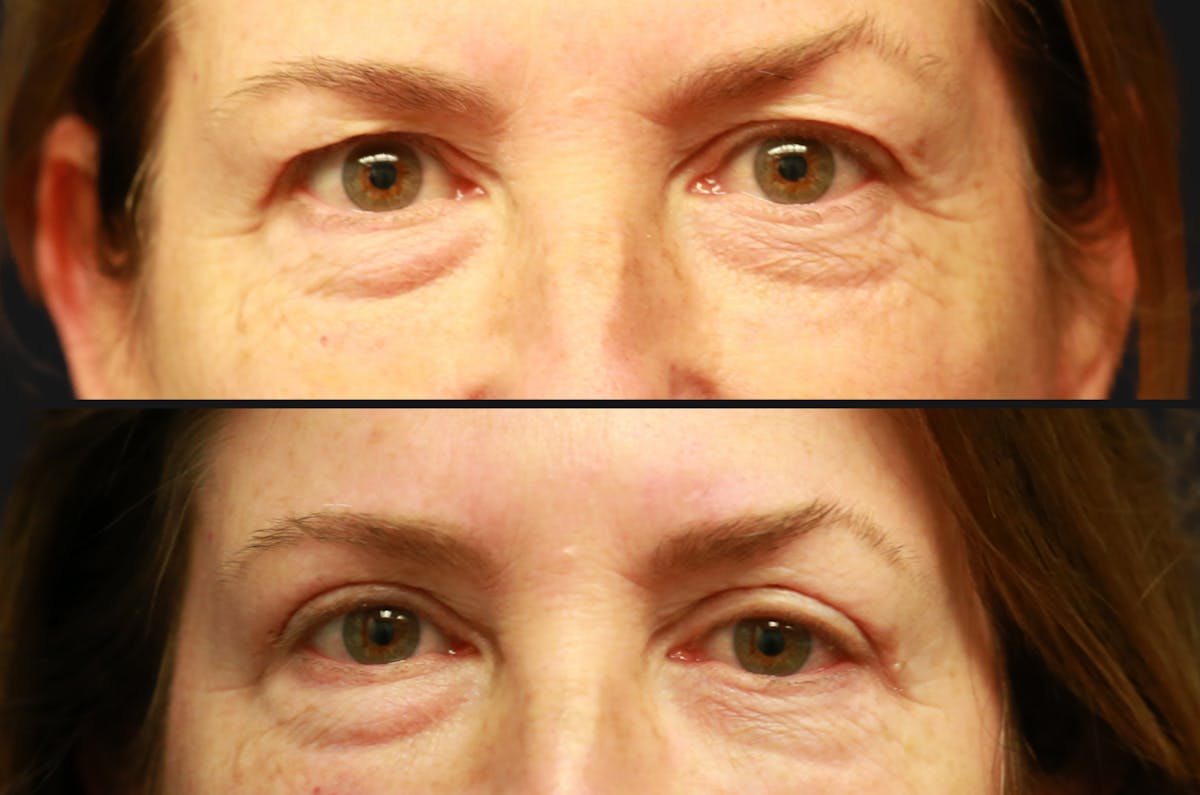 Upper Blepharoplasty Before & After Gallery - Patient 410041 - Image 2