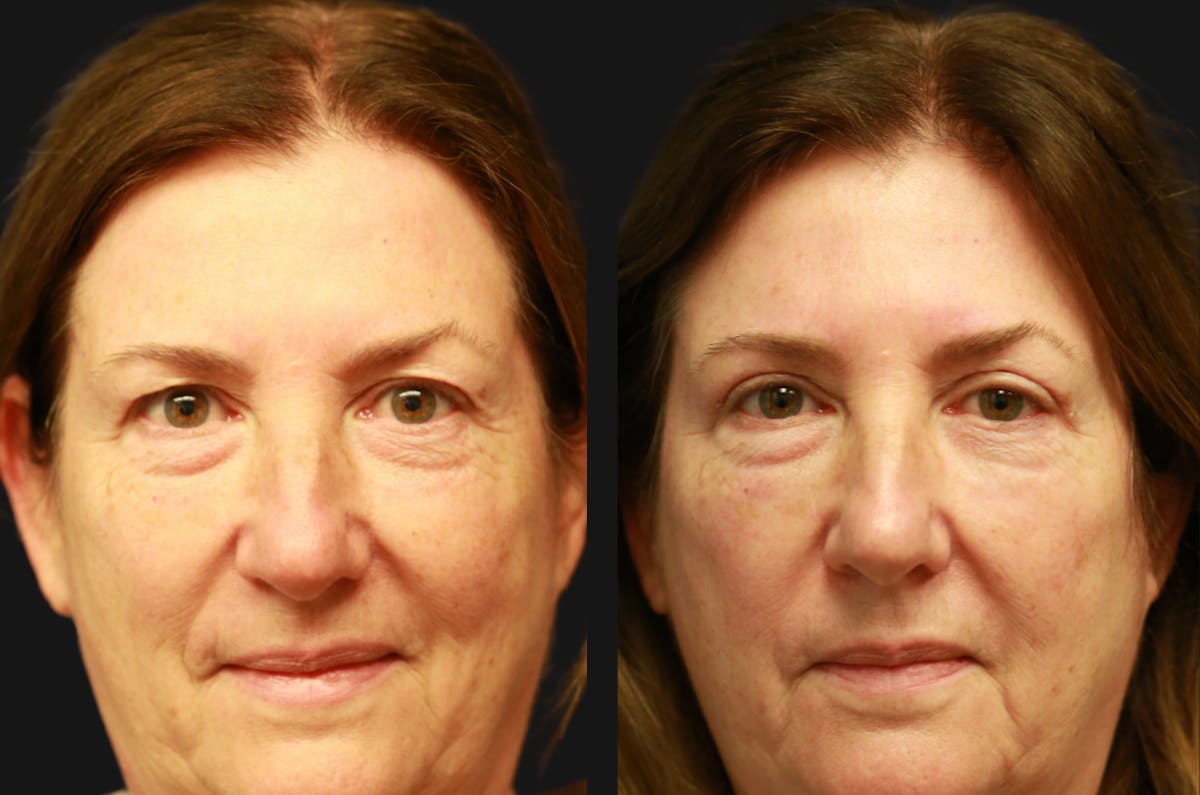 Upper Blepharoplasty Before & After Gallery - Patient 410041 - Image 1