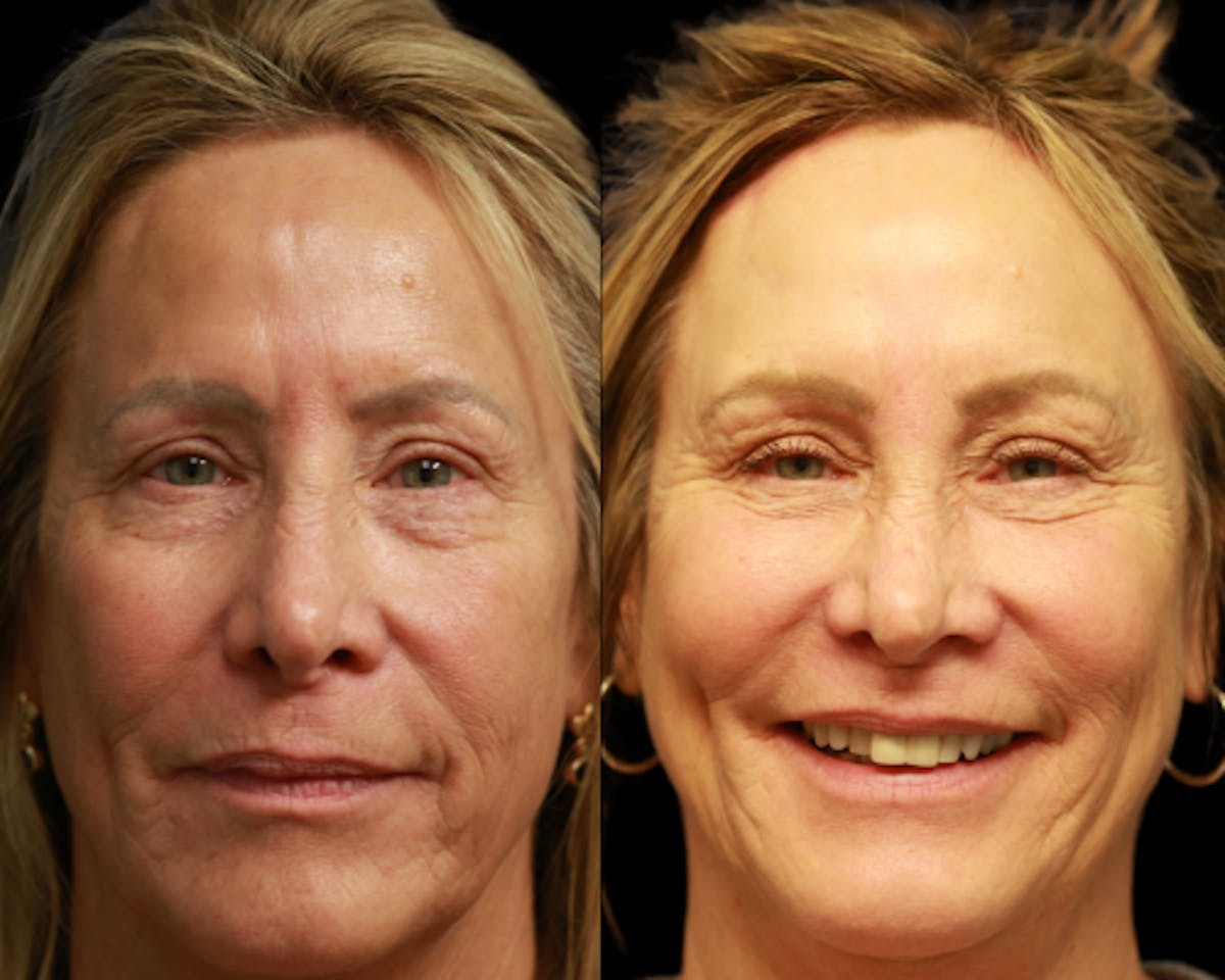 Lower Blepharoplasty Before & After Gallery - Patient 382605 - Image 1