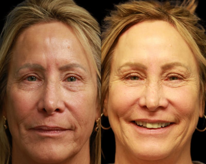 CO2 Laser Skin Resurfacing Before & After Gallery - Patient 200084 - Image 1
