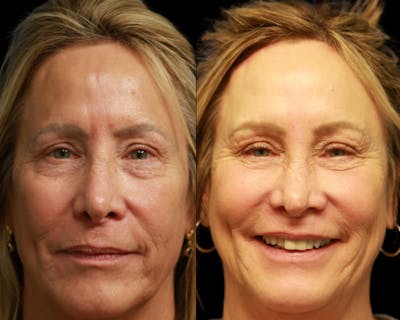 CO2 Laser Skin Resurfacing Before & After Gallery - Patient 200084 - Image 1