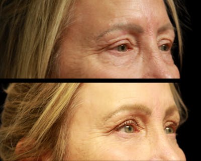 CO2 Laser Skin Resurfacing Before & After Gallery - Patient 200084 - Image 2