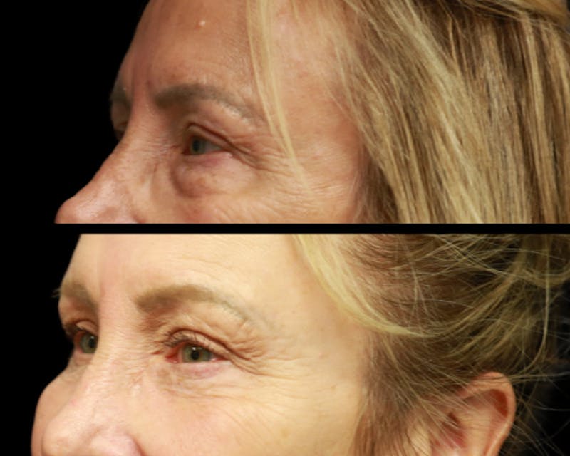 CO2 Laser Skin Resurfacing Before & After Gallery - Patient 200084 - Image 3