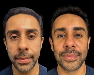 Facial Fat Transfer Before & After Gallery - Patient 382228 - Image 1