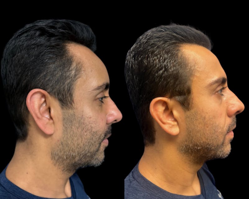 Facial Fat Transfer Before & After Gallery - Patient 382228 - Image 2