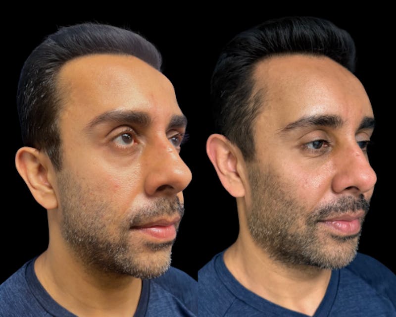 Facial Fat Transfer Before & After Gallery - Patient 382228 - Image 3
