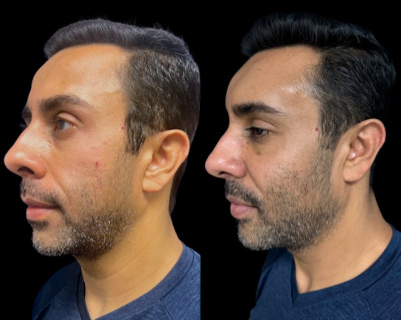 Facial Fat Transfer Before & After Gallery - Patient 382228 - Image 5
