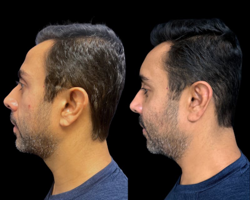 Facial Fat Transfer Before & After Gallery - Patient 382228 - Image 4