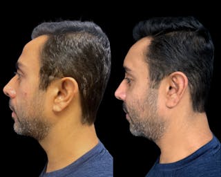 Facial Fat Transfer Before & After Gallery - Patient 382228 - Image 4
