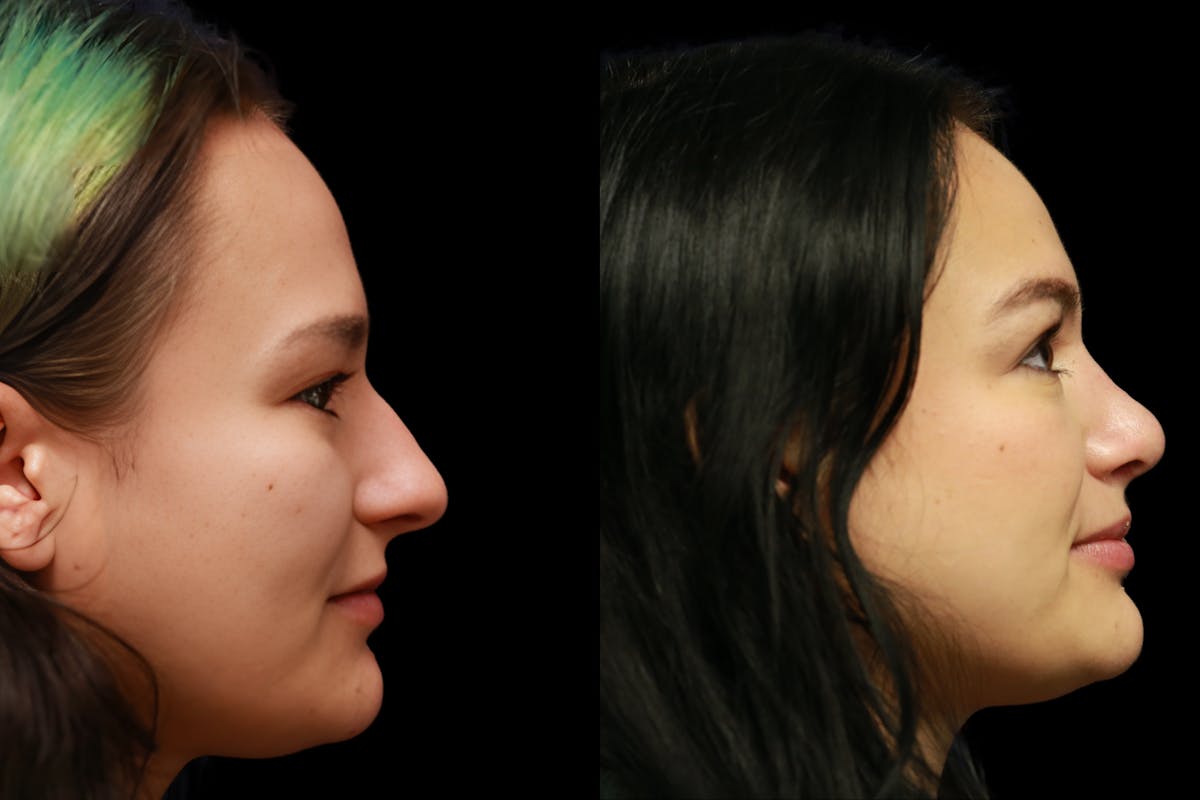 Rhinoplasty Before & After Gallery - Patient 805031 - Image 1