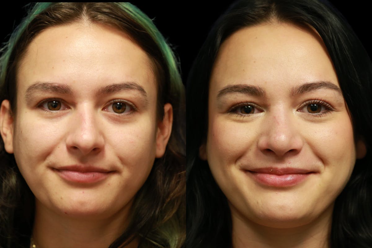 Rhinoplasty Before & After Gallery - Patient 805031 - Image 3