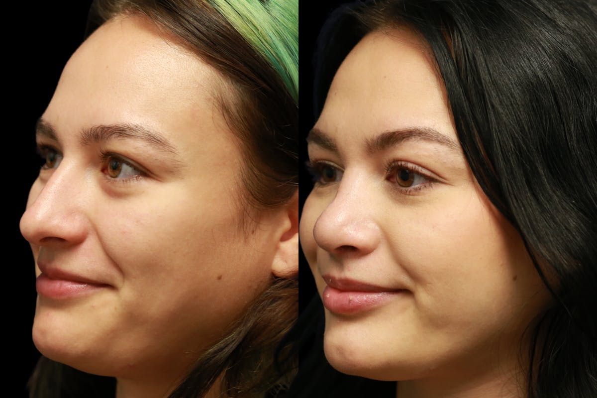 Rhinoplasty Before & After Gallery - Patient 805031 - Image 5