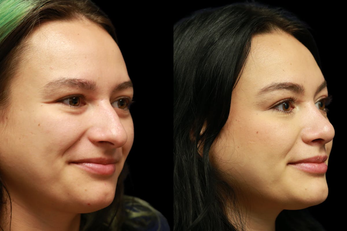 Rhinoplasty Before & After Gallery - Patient 805031 - Image 2