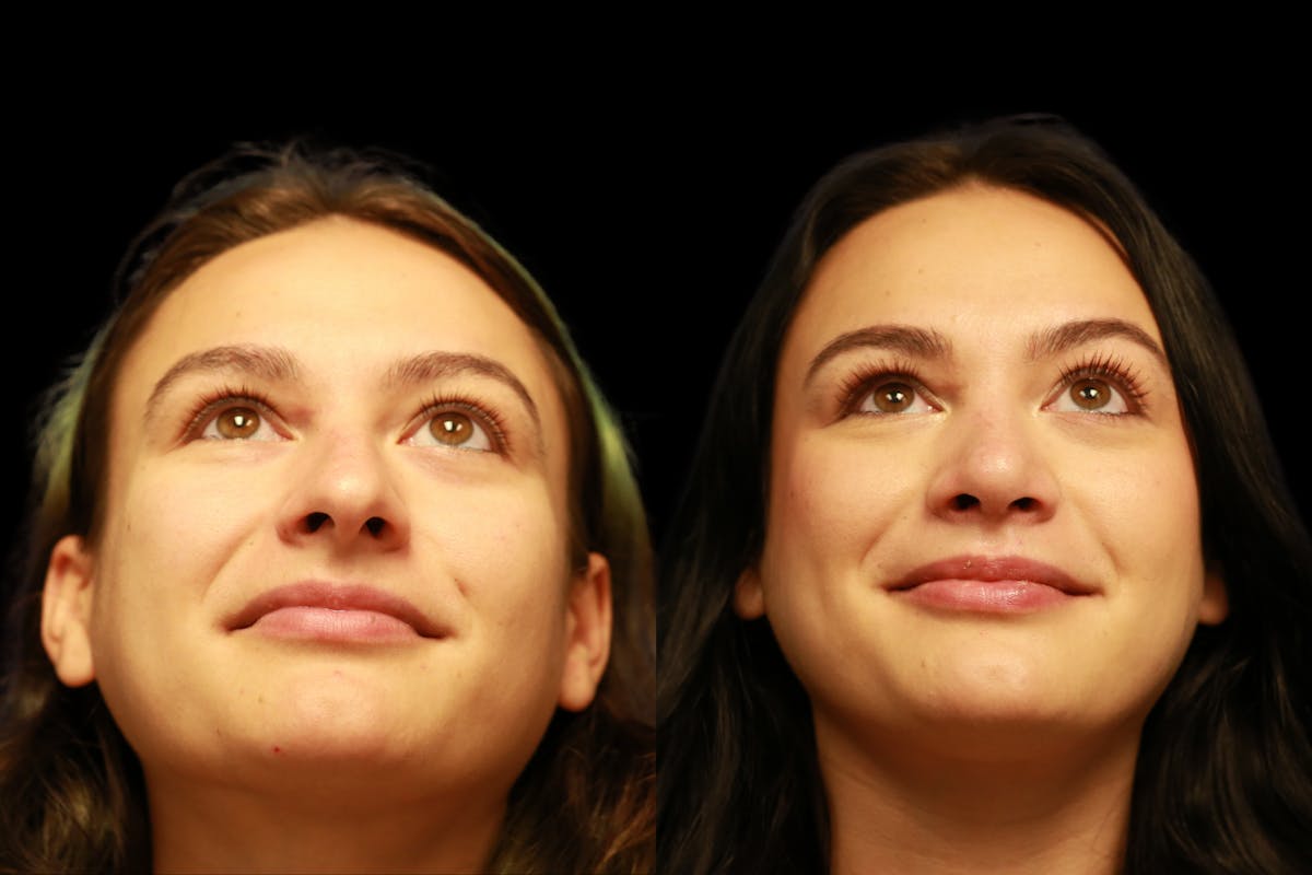 Rhinoplasty Before & After Gallery - Patient 805031 - Image 4