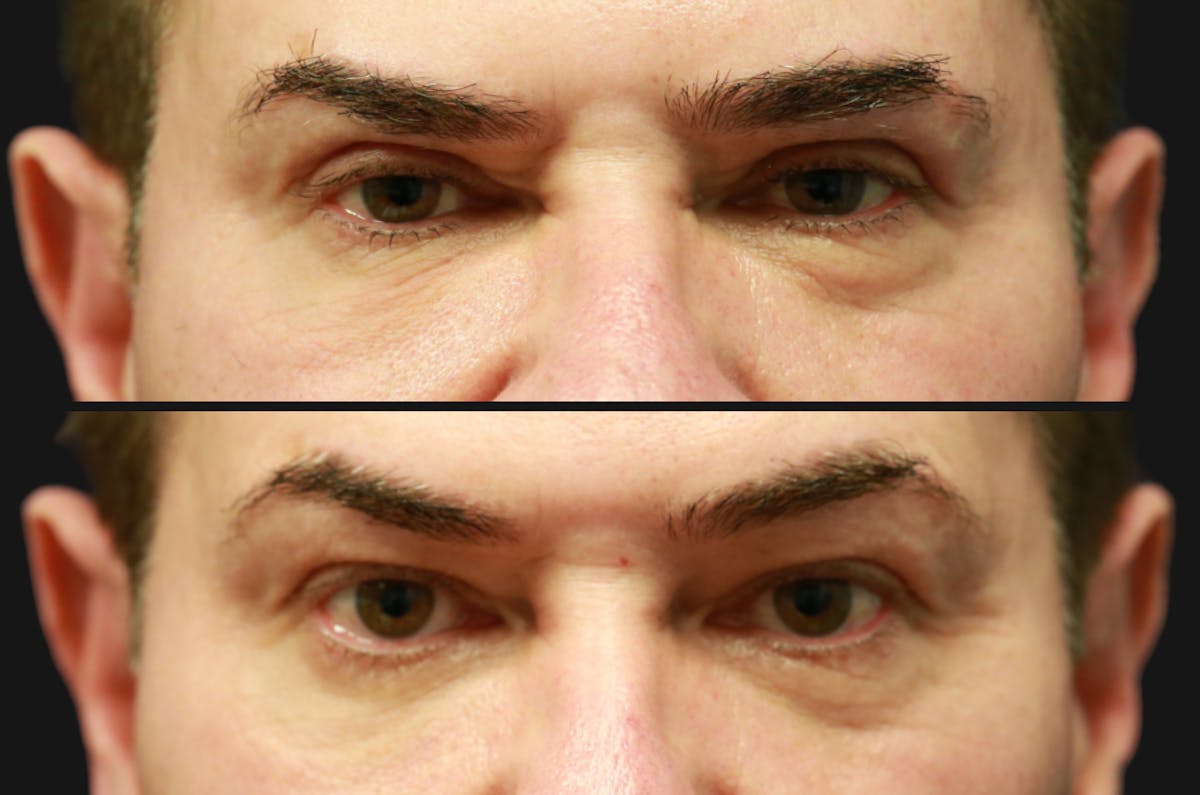 Upper Blepharoplasty Before & After Gallery - Patient 686935 - Image 1