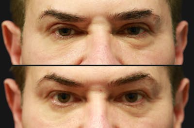 Upper Blepharoplasty Before & After Gallery - Patient 686935 - Image 1