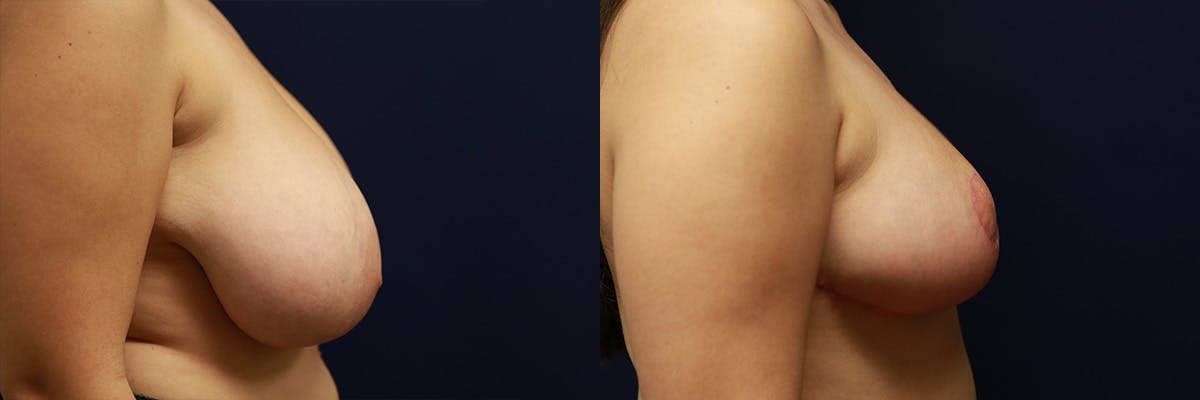 Breast Reduction Before & After Gallery - Patient 346805 - Image 3