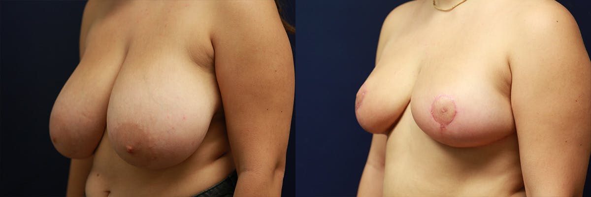 Breast Reduction Before & After Gallery - Patient 346805 - Image 4