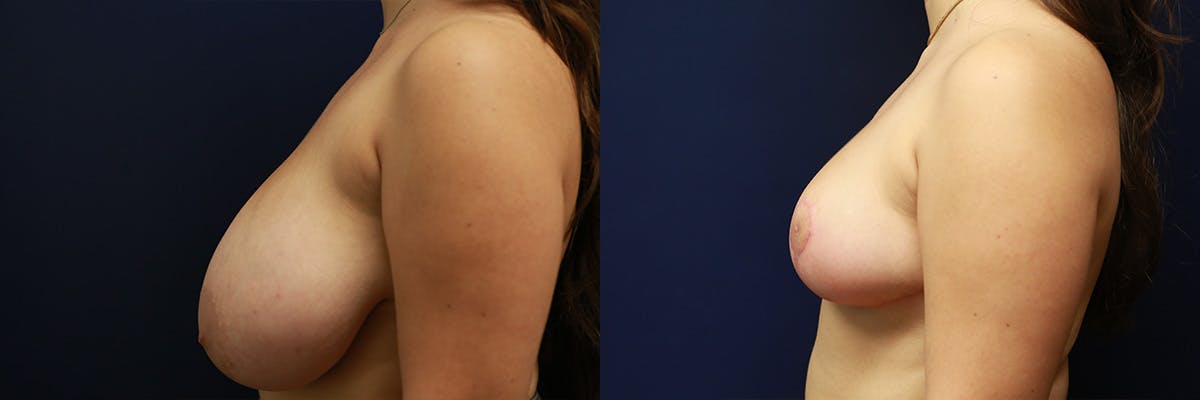 Breast Reduction Before & After Gallery - Patient 346805 - Image 5