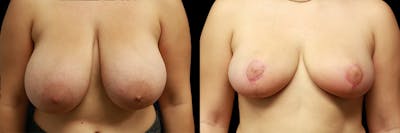 Breast Reduction Before & After Gallery - Patient 346805 - Image 1