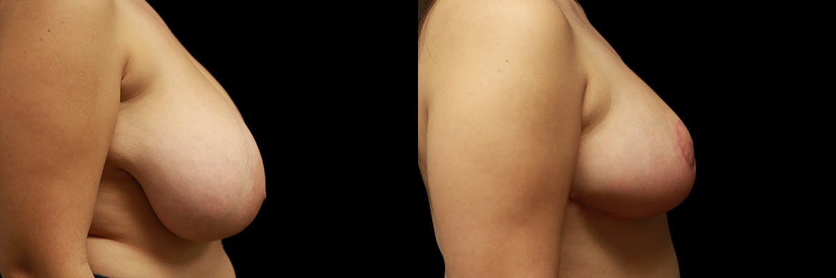 Breast Reduction Before & After Gallery - Patient 346805 - Image 3