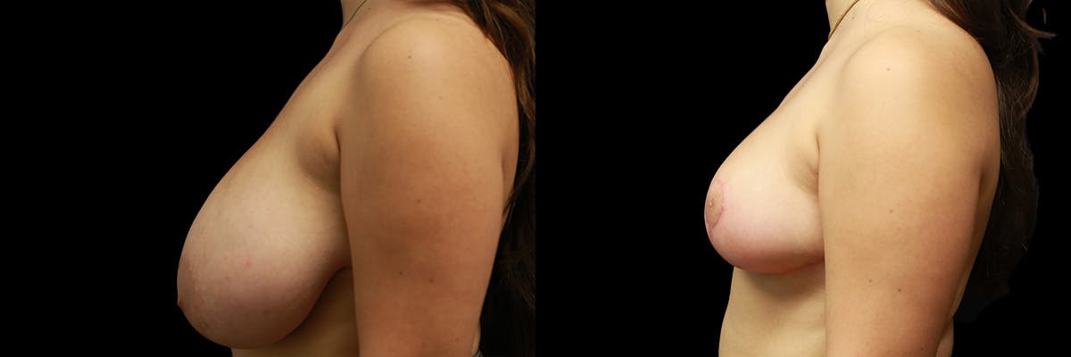 Breast Reduction Before & After Gallery - Patient 346805 - Image 5