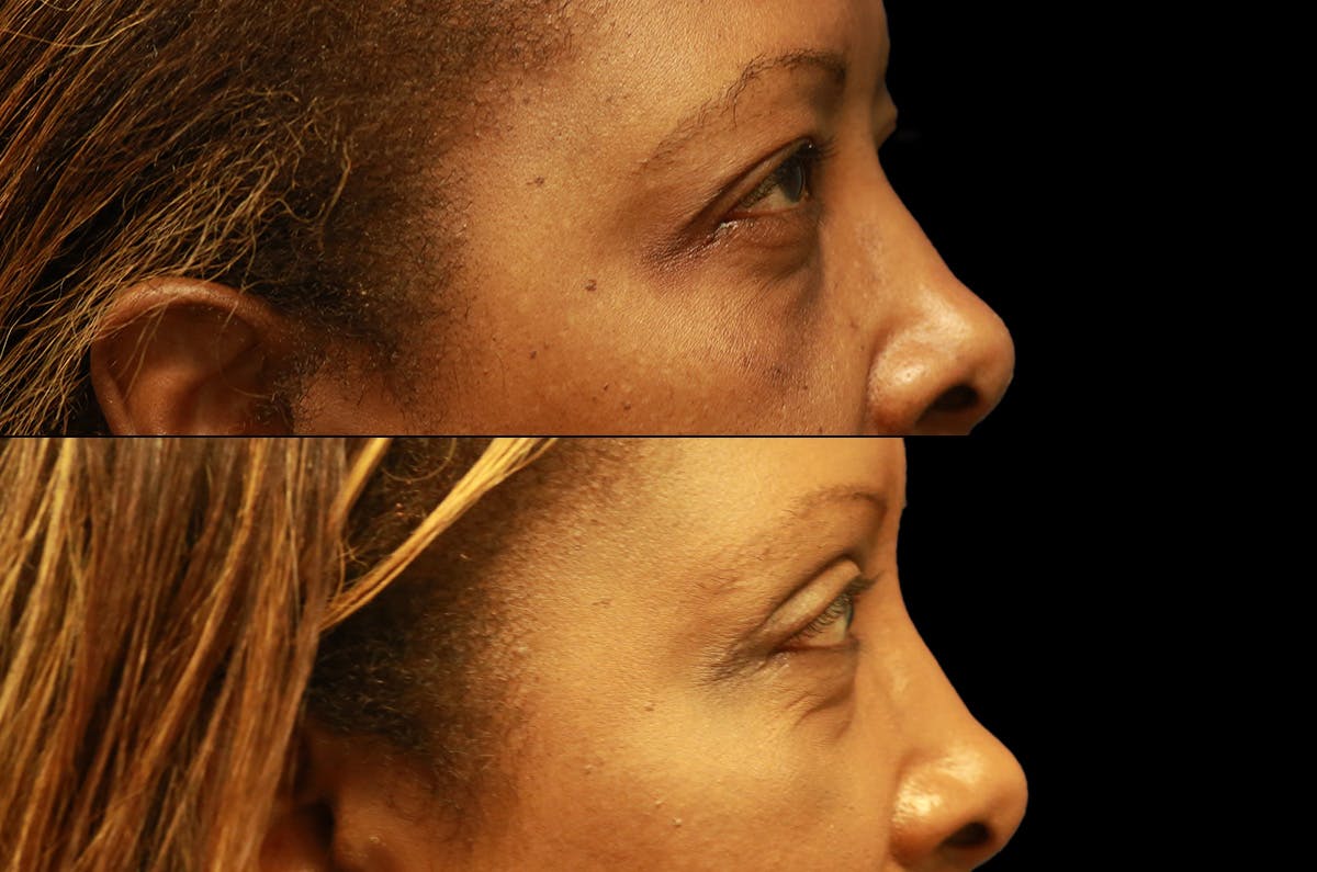 Upper Blepharoplasty Before & After Gallery - Patient 273221 - Image 3