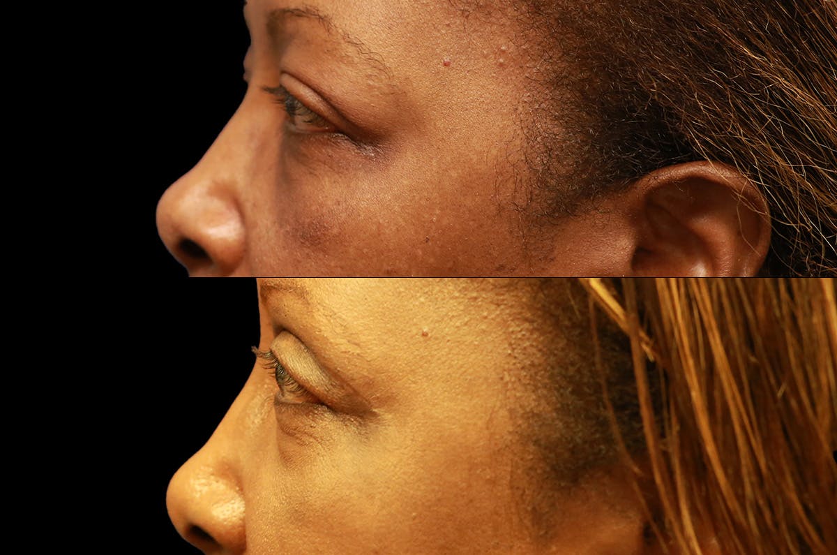 Upper Blepharoplasty Before & After Gallery - Patient 273221 - Image 5