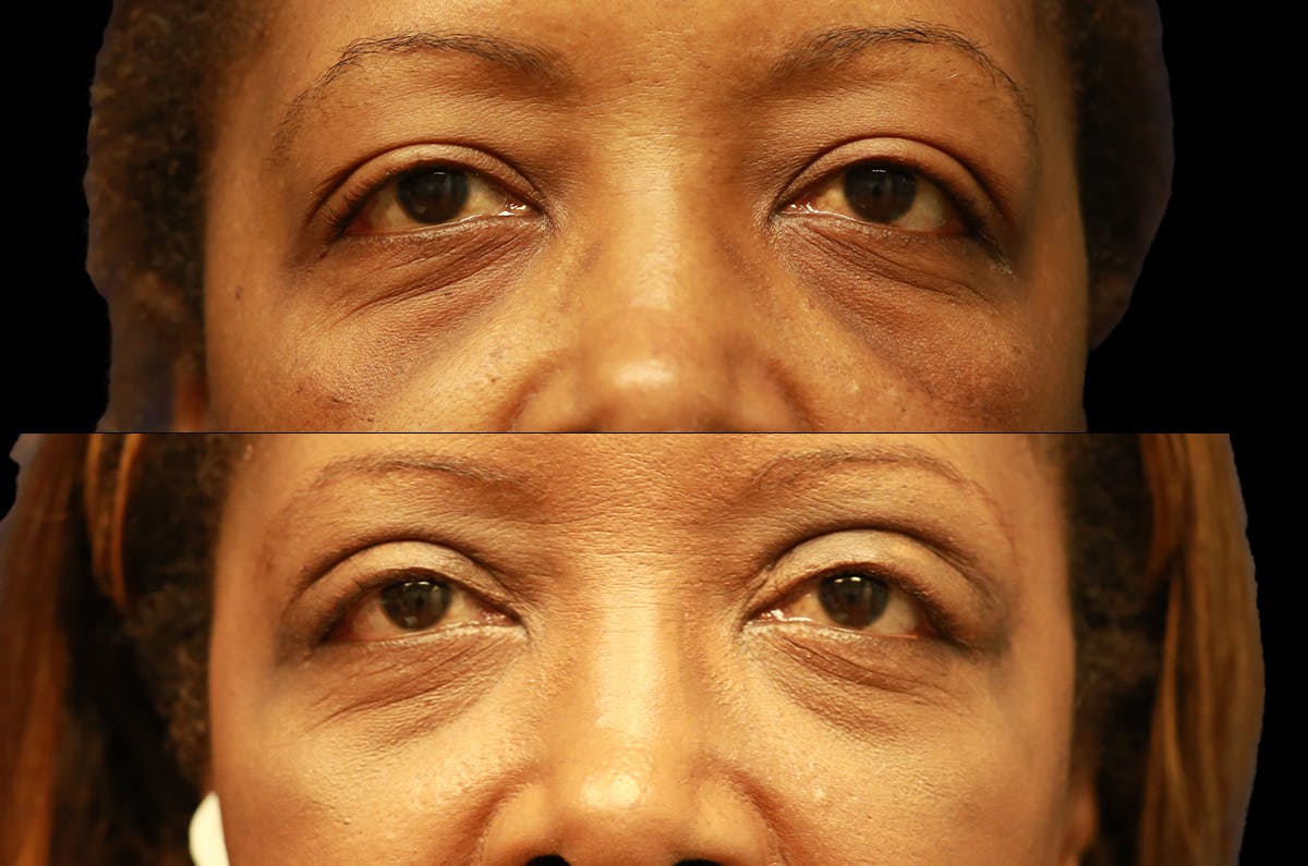 Upper Blepharoplasty Before & After Gallery - Patient 273221 - Image 1