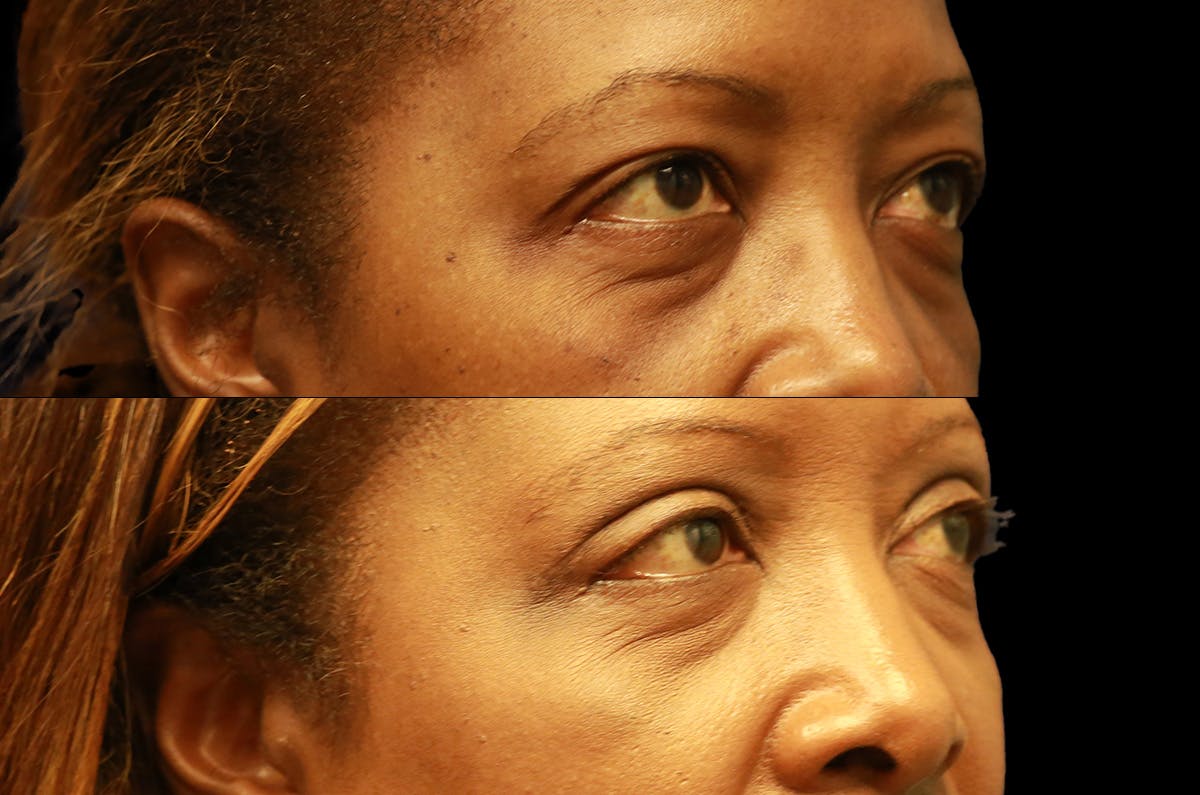 Upper Blepharoplasty Before & After Gallery - Patient 273221 - Image 2