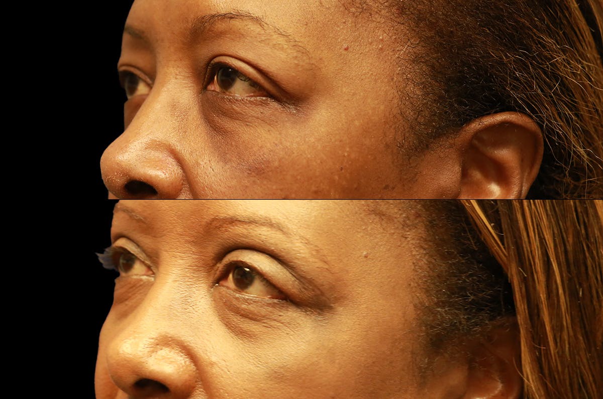 Upper Blepharoplasty Before & After Gallery - Patient 273221 - Image 4