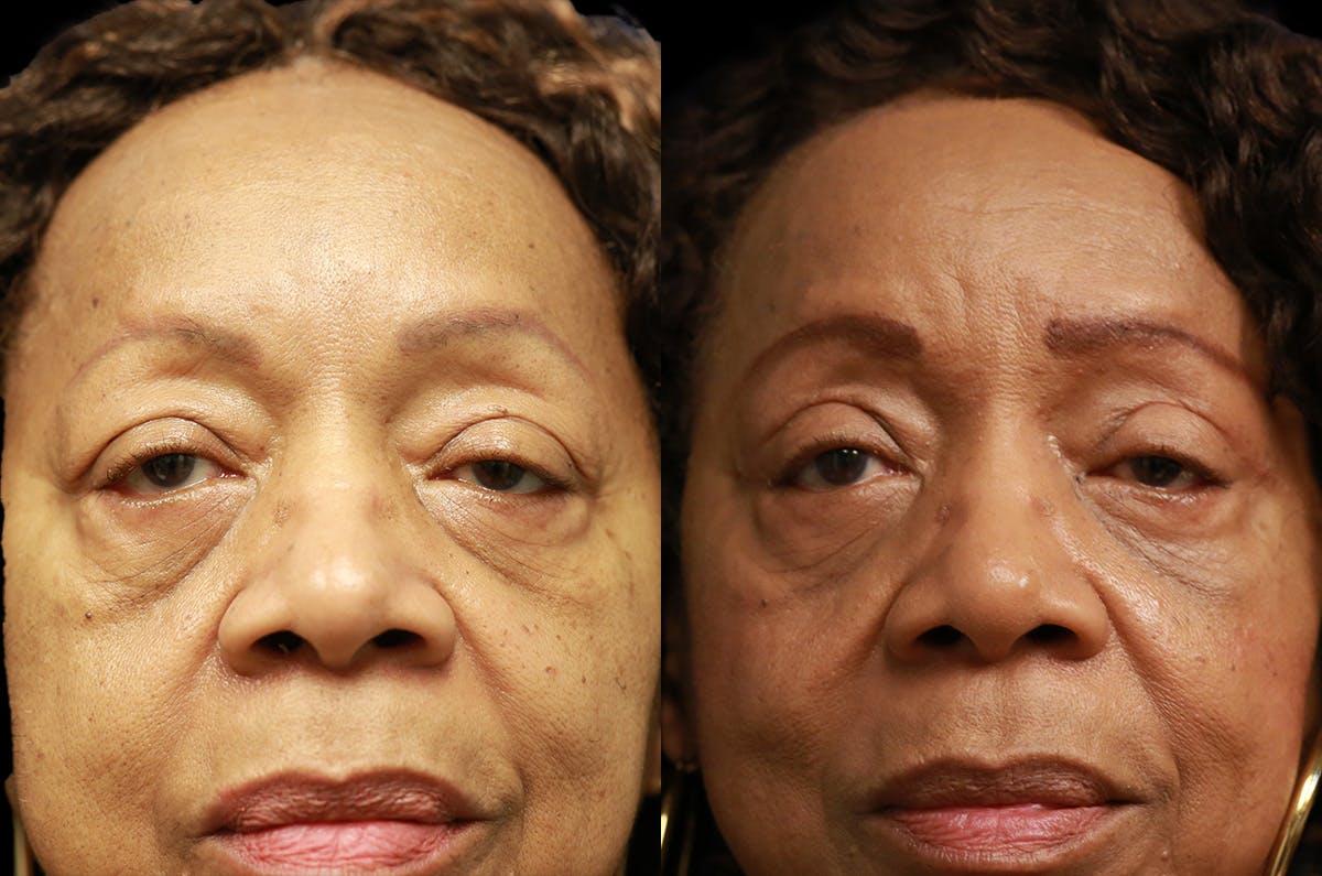 Upper Blepharoplasty Before & After Gallery - Patient 443837 - Image 1