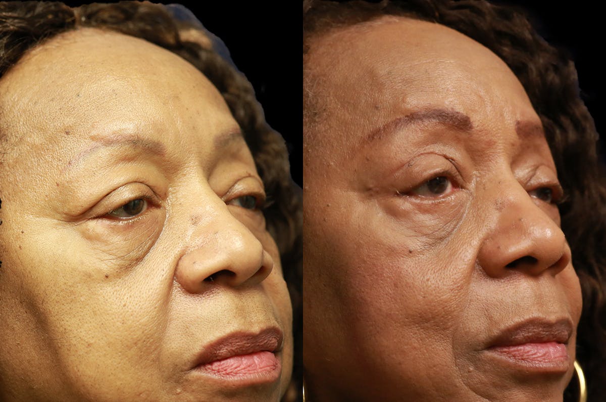 Upper Blepharoplasty Before & After Gallery - Patient 443837 - Image 2