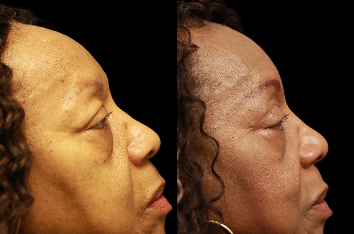 Upper Blepharoplasty Before & After Gallery - Patient 443837 - Image 3