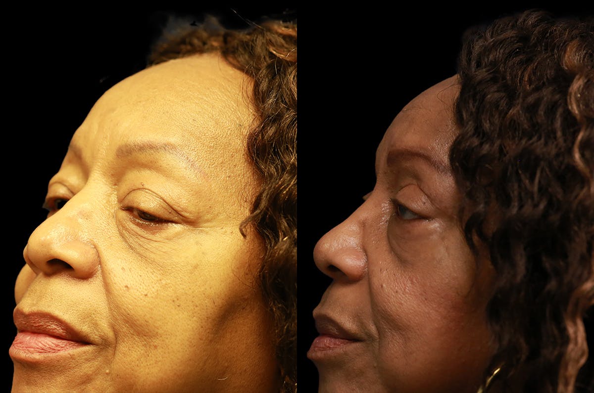 Upper Blepharoplasty Before & After Gallery - Patient 443837 - Image 4