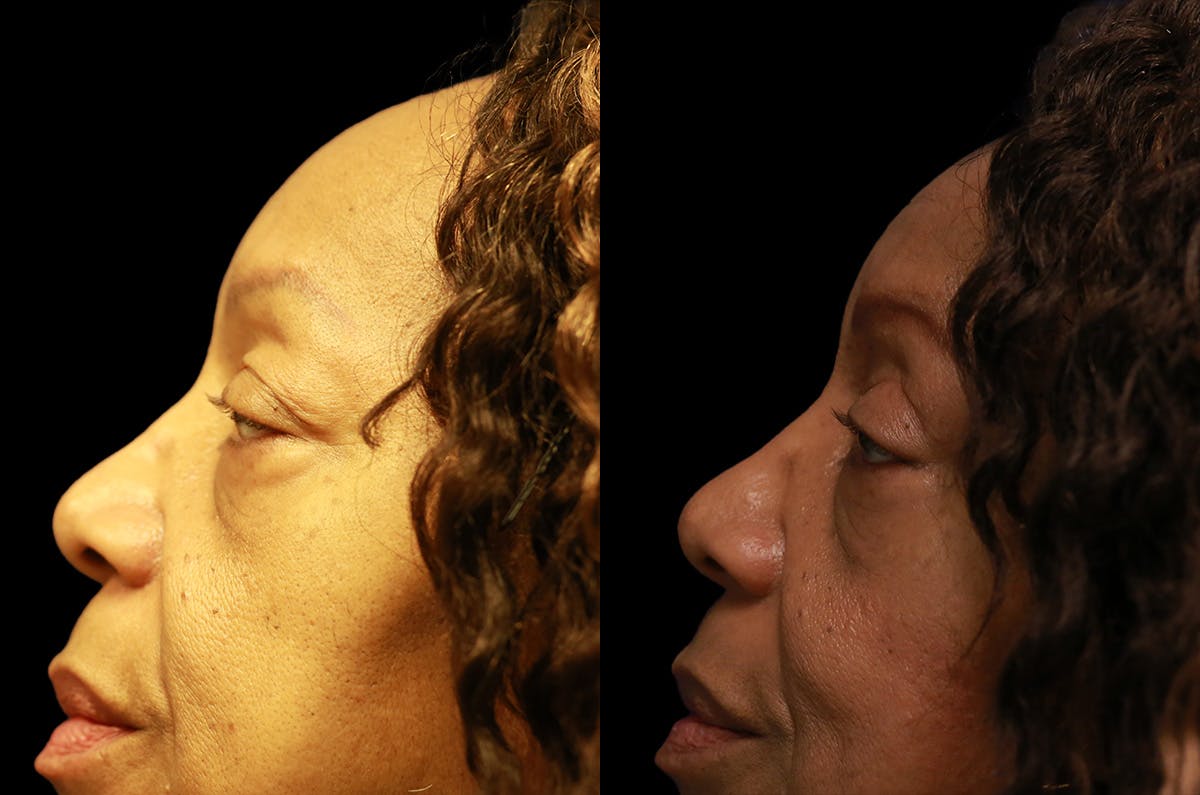 Upper Blepharoplasty Before & After Gallery - Patient 443837 - Image 5