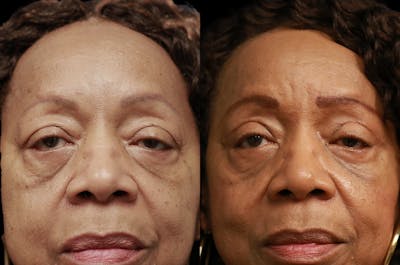 Upper Blepharoplasty Before & After Gallery - Patient 443837 - Image 1