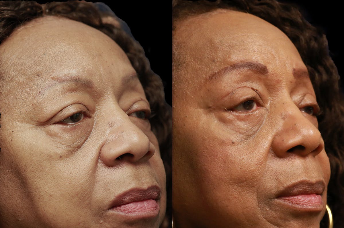 Upper Blepharoplasty Before & After Gallery - Patient 443837 - Image 2