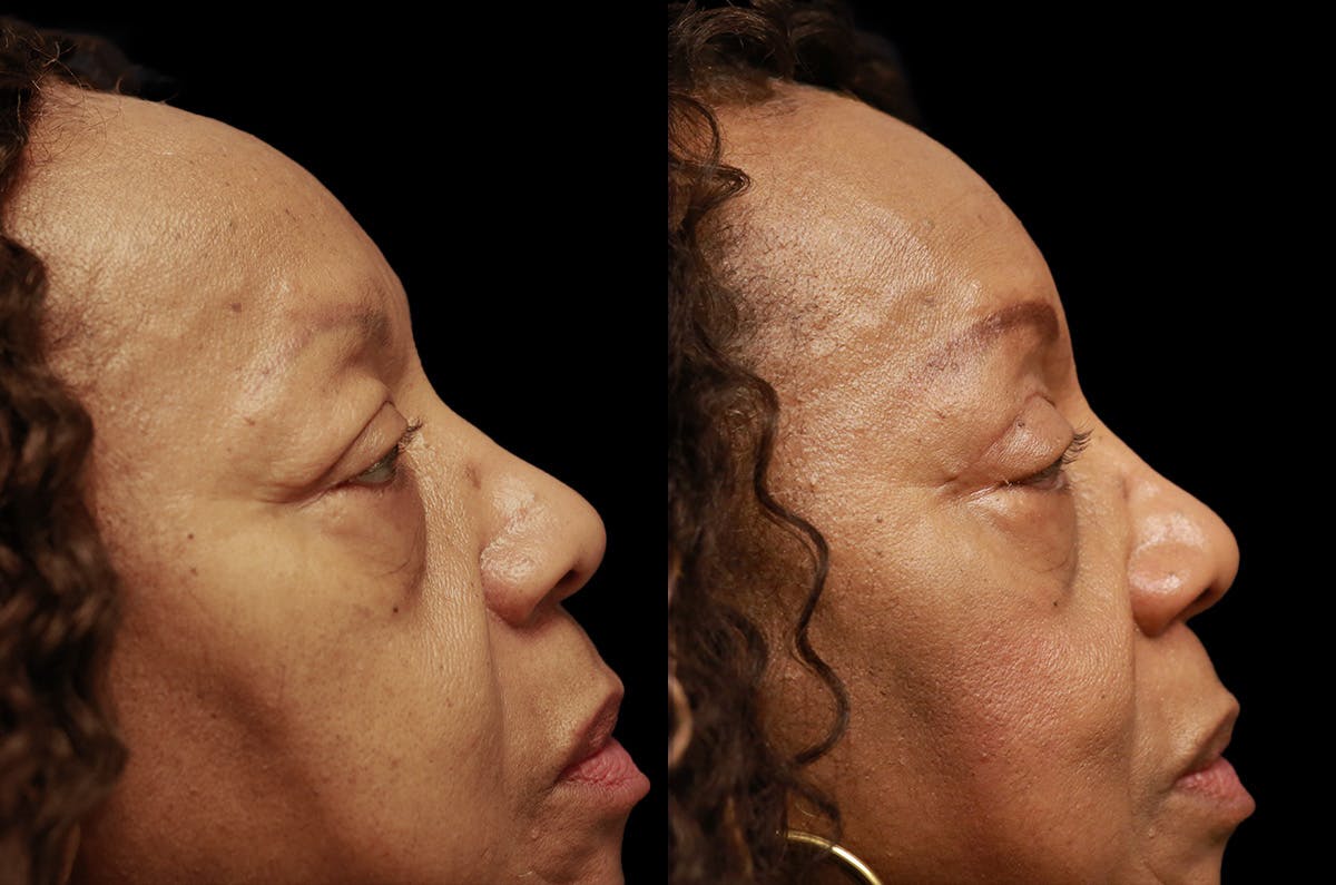 Upper Blepharoplasty Before & After Gallery - Patient 443837 - Image 3