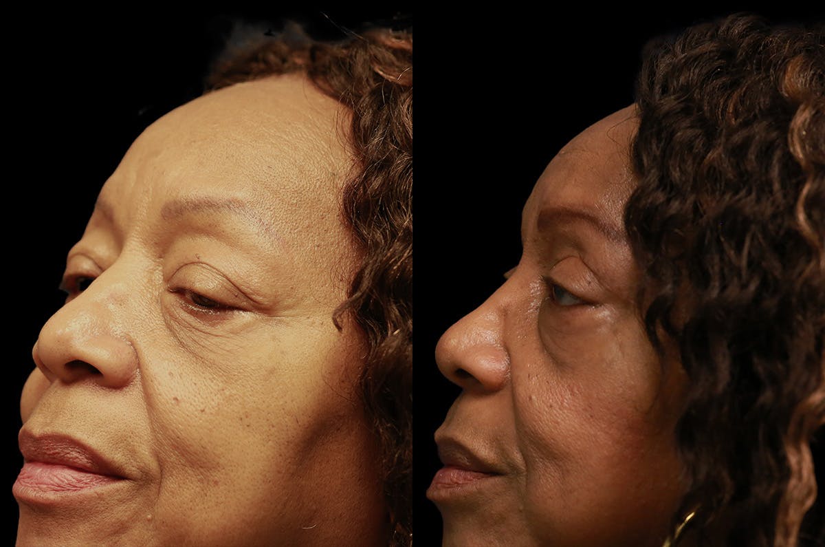Upper Blepharoplasty Before & After Gallery - Patient 443837 - Image 4