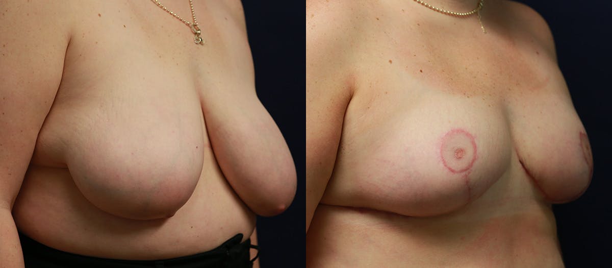 Breast Reduction Before & After Gallery - Patient 370124 - Image 2