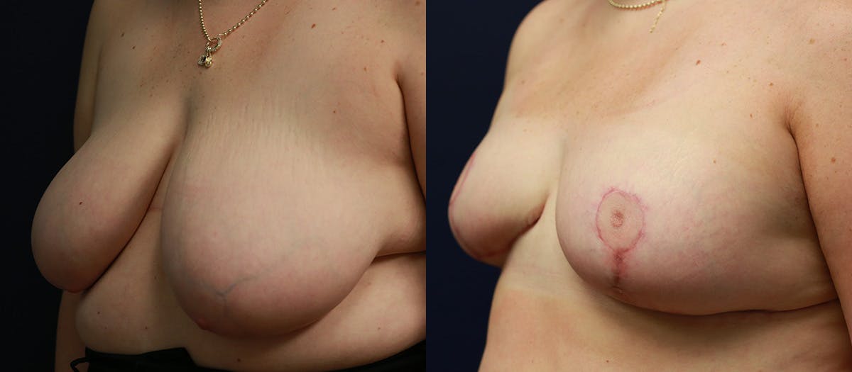 Breast Reduction Before & After Gallery - Patient 370124 - Image 4