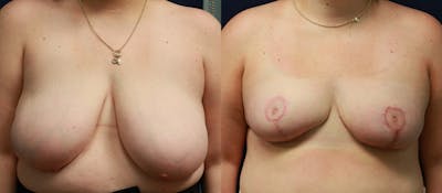 Breast Reduction Before & After Gallery - Patient 370124 - Image 1
