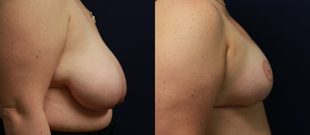 Breast Reduction Before & After Gallery - Patient 370124 - Image 3