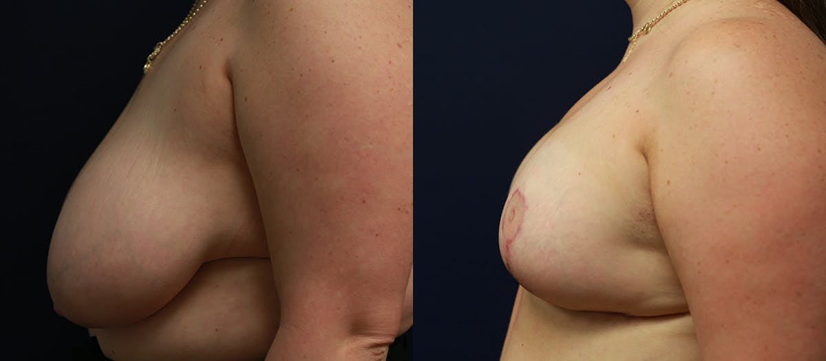 Breast Reduction Before & After Gallery - Patient 370124 - Image 5