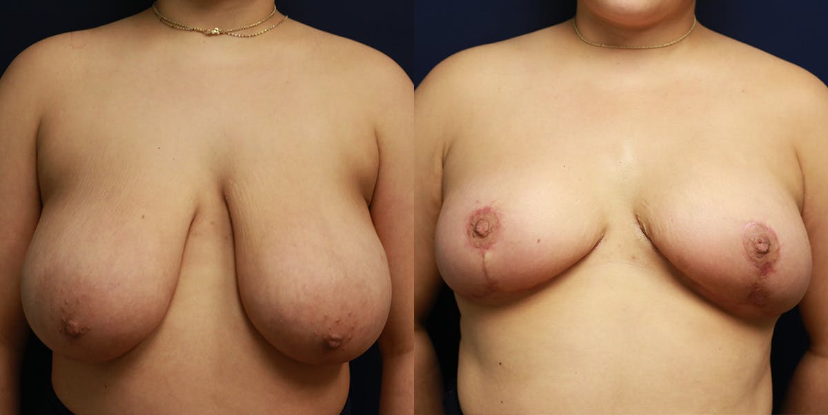 Breast Reduction Before & After Gallery - Patient 223641 - Image 1