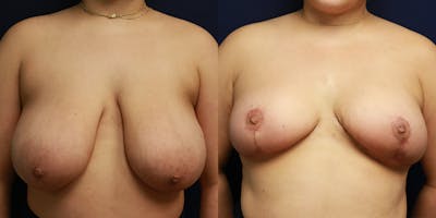 Breast Reduction Before & After Gallery - Patient 223641 - Image 1